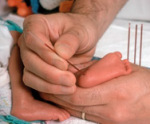 baby heel prick